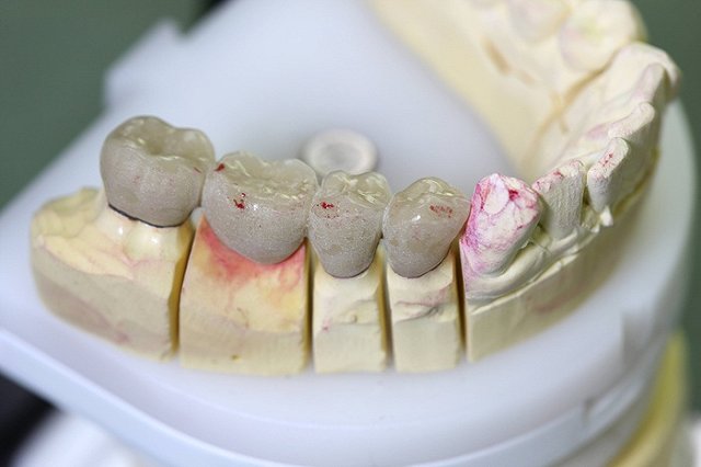 В Екатеринбурге стоматолог без образования ставил импланты