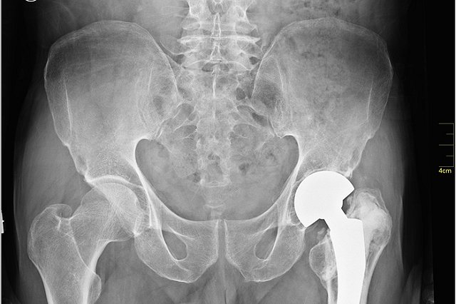 В регионе запускают новый проект по лечению тяжелейшего перелома шейки бедра