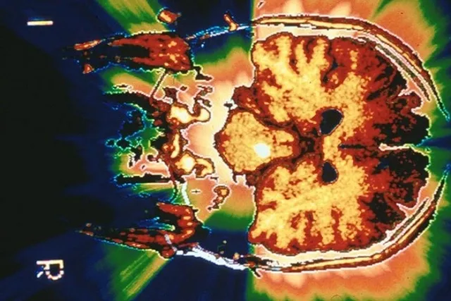 В Екатеринбурге ученый придумал новый метод лечения опухоли мозга