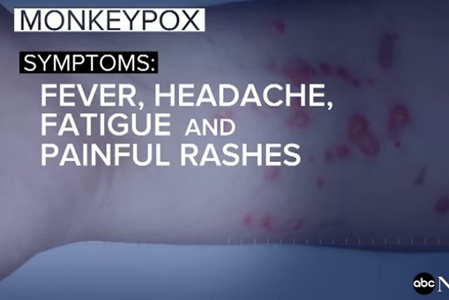 В Нью-Йорке призвали переименовать оспу обезьян из-за чувств чернокожих