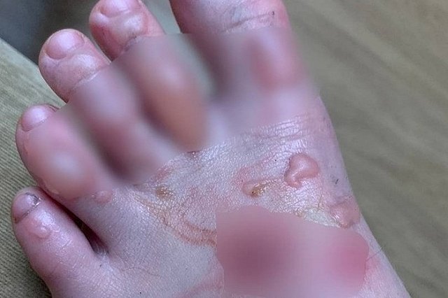 Маленький пассажир «Уральских авиалиний» сильно обжег ногу в самолете