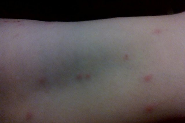 «Желание содрать с себя кожу»: екатеринбурженка, купающаяся на Шарташе, подхватила «утиные глисты»