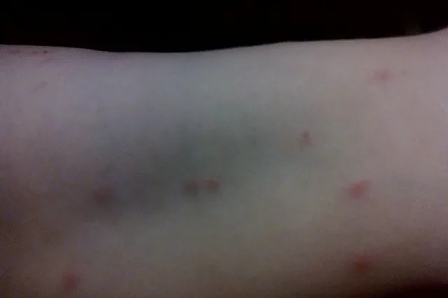 «Желание содрать с себя кожу»: екатеринбурженка, купающаяся на Шарташе, подхватила «утиные глисты»