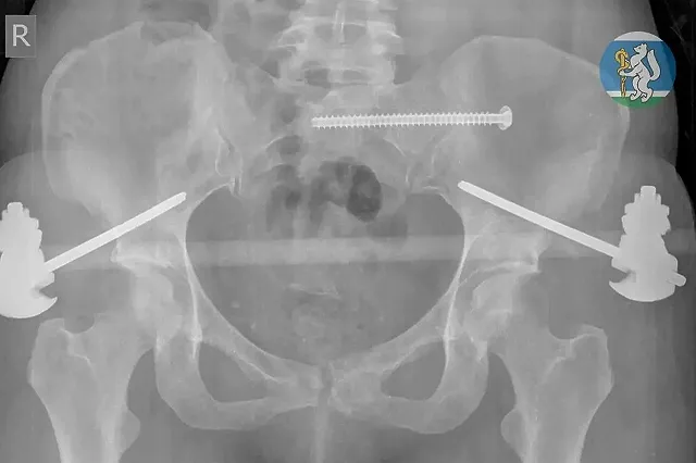 Екатеринбурженка выжила, выпав с 7-ого этажа во время мытья окон