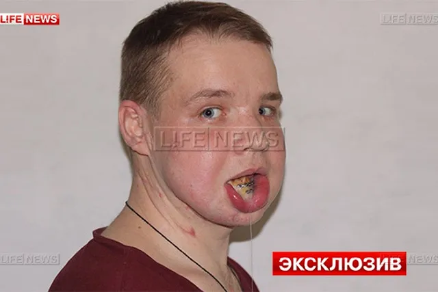 Выжившему в схватке с медведем карпинцу собрали челюсть из костей таза