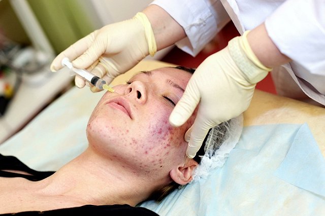 Названа причина появления прыщей