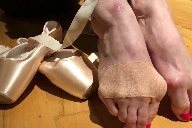 Врачи пугают Волочкову гангреной