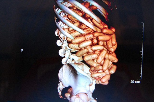 Кусавшийся пассажир рейса Лиссабон-Дублин перевозил в желудке кокаин