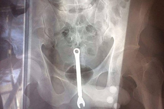 За новогодние праздники автослесаря дважды госпитализировали с гаечным ключом в заднем проходе