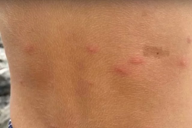 Уральцы пожаловались на зуд и сыпь после купания в озере