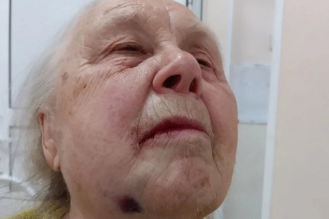 Пожилая свердловчанка рассказала, как ей два часа вырывали зуб мудрости