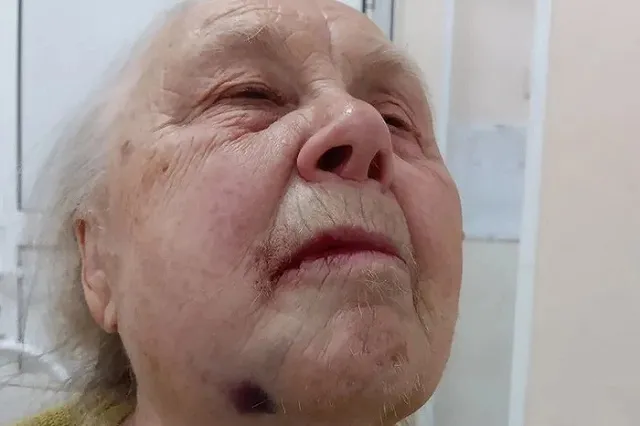 Пожилая свердловчанка рассказала, как ей два часа вырывали зуб мудрости