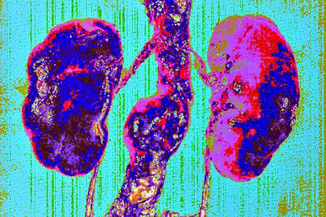 Рак заморозили и убили. Такого в России еще никто не делал