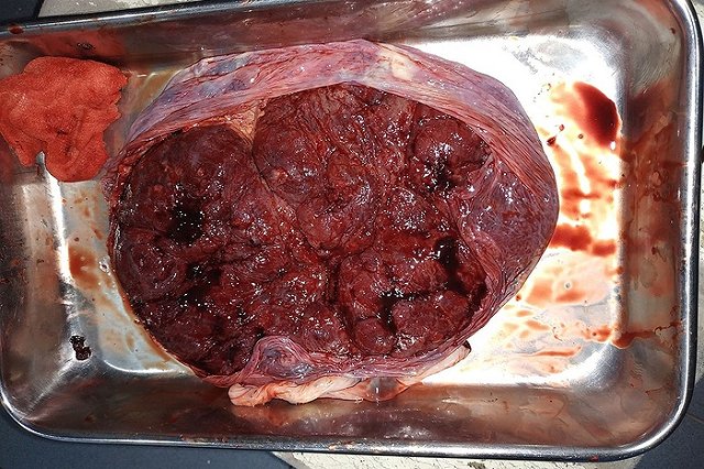 Женщина съела собственную плаценту и поделилась впечатлениями