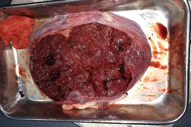 Женщина съела собственную плаценту и поделилась впечатлениями