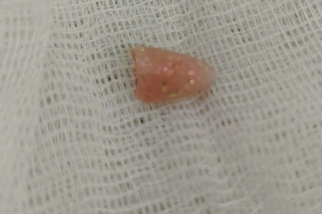 На Урале врачи достали из дыхательных путей 10-месячного малыша нарощенный ноготь