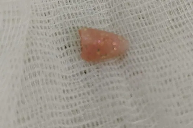 На Урале врачи достали из дыхательных путей 10-месячного малыша нарощенный ноготь