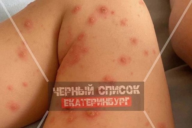 После купания в бассейне «Баден-Бадена» на Уктусе ребёнок заразился ветрянкой