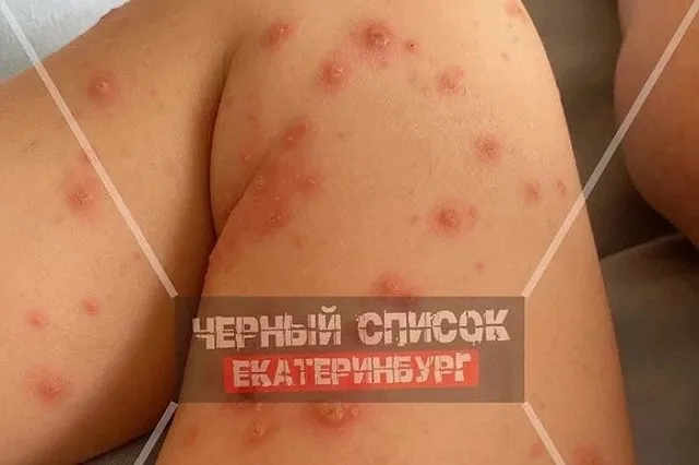 После купания в бассейне «Баден-Бадена» на Уктусе ребёнок заразился ветрянкой
