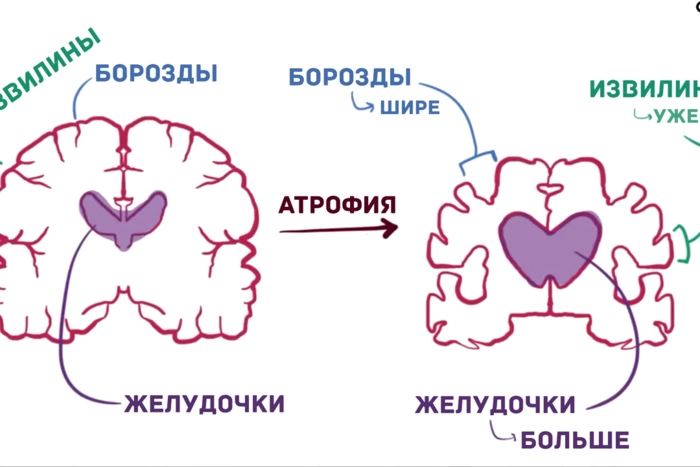 Журнал The Lancet опубликовал «тест» на ранние признаки болезни Альцгеймера