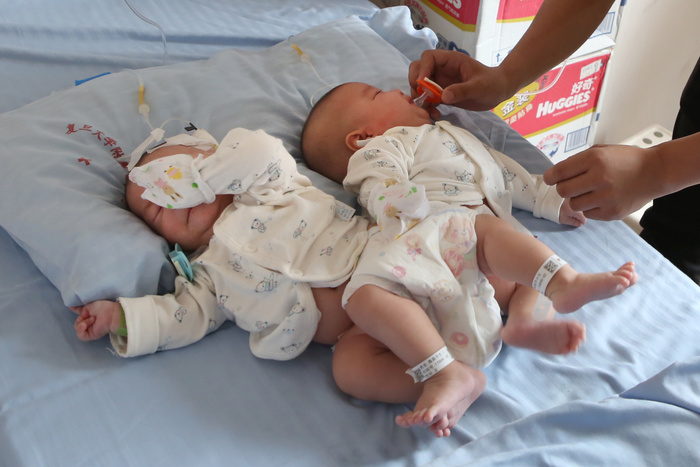 Сиамских близнецов разделили в утробе матери при помощи лазера в Екатеринбурге