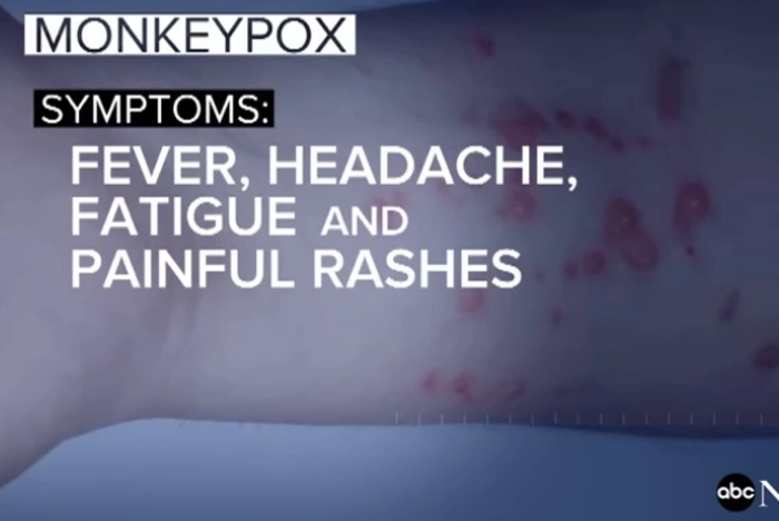 В Нью-Йорке призвали переименовать оспу обезьян из-за чувств чернокожих