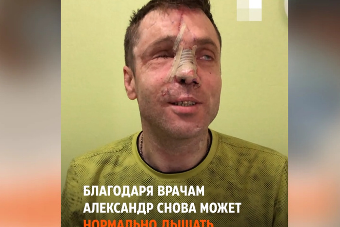 Екатеринбургские врачи восстановили лицо мужчине из Донецка, который подорвался на мине