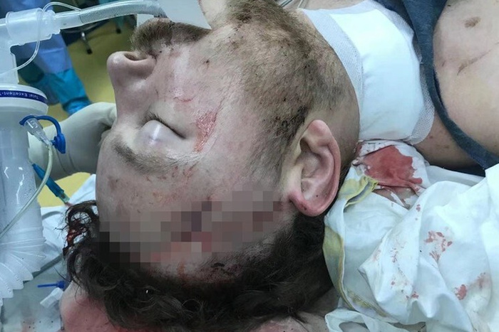 Госпитализировали с открытым переломом черепа: екатеринбуржец выпал с 6-ого этажа в Китае