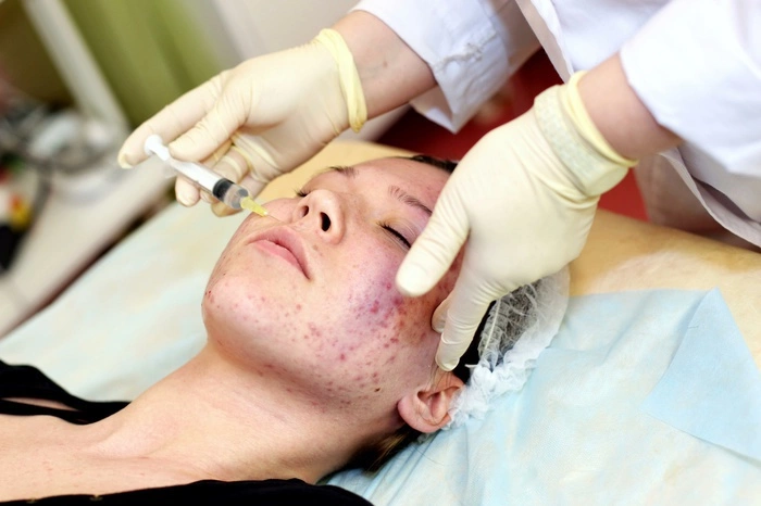 Названа причина появления прыщей