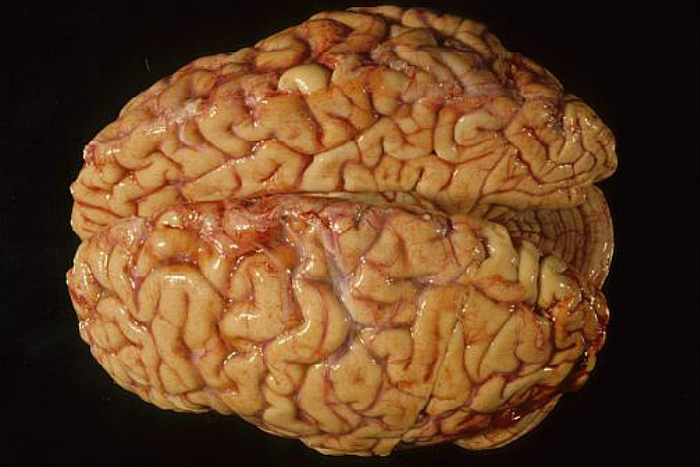 Ученые: С годами мозг человека тоже покрывается морщинами