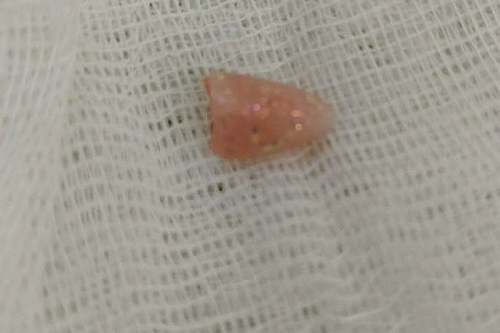 На Урале врачи достали из дыхательных путей 10-месячного малыша нарощенный ноготь