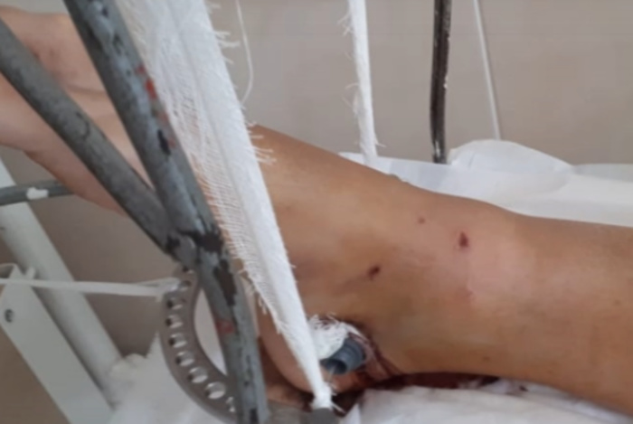 Улетавшая на отдых из Кольцово югорчанка сломала ногу в центре Екатеринбурга