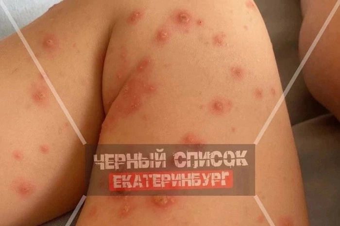 После купания в бассейне «Баден-Бадена» на Уктусе ребёнок заразился ветрянкой